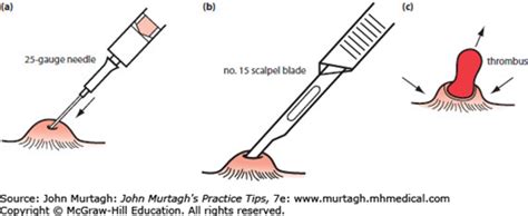 Treatment Of Ano Rectal Problems Murtaghs Practice Tips 7e