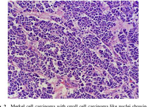 Different staging systems make it difficult to compare the. Figure 2 from Advances in Merkel cell carcinoma from a ...