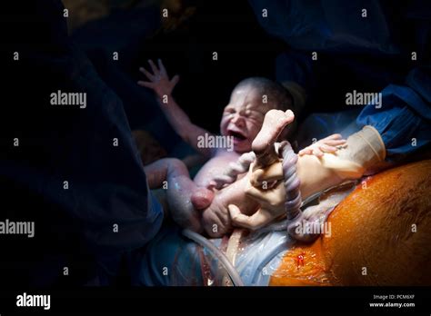 A Woman Giving Birth To Twins By Caesarean Section Heverlee Stock Photo Alamy