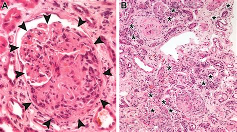 From Head To Toe Granulomatosis With Polyangiitis Radiographics