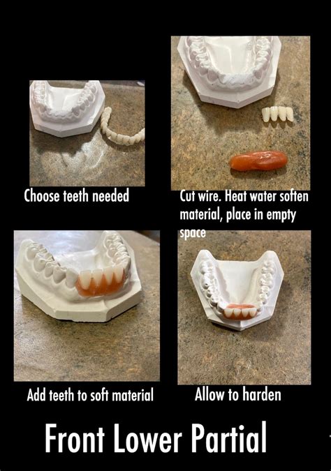 Do It Yourself Denture Kit Make Your Own Temporary Etsy Denture Affordable Dentures Fix Teeth