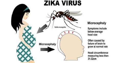 diagnosis of zika virus symptoms pregnancy and fertility treatment