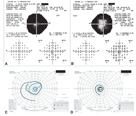 Visual Field Defect American Academy Of Ophthalmology