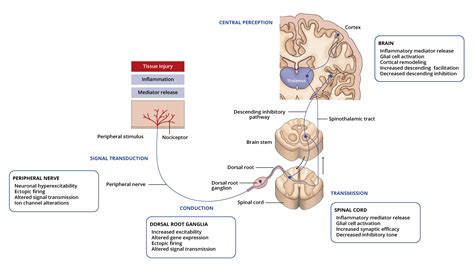 Neuropathic Pain Etiology Pathophysiology And Diagnosis Openanesthesia