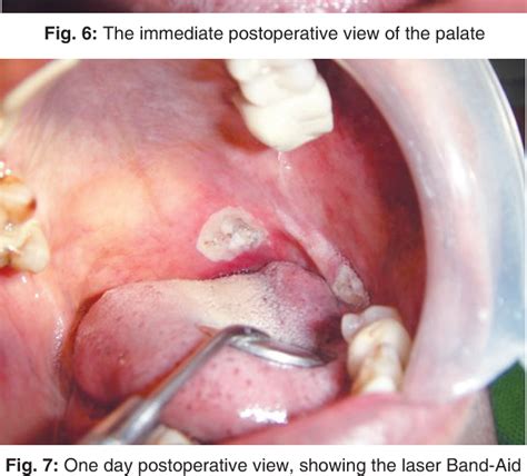 Figure From Management Of Oral Pyogenic Granuloma With Nm Diode