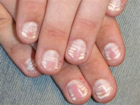 Some forms of poisoning or medication can also cause leukonychia. Leukonychia (witte nagels)