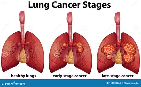 Lung Cancer Symptoms Stages