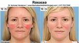 Images of Laser Treatments For Rosacea On Face