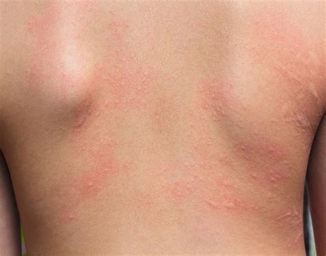 Hautallergie Symptome Bilder Allergischer Hautausschlag My XXX Hot Girl