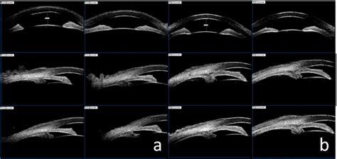 Ultrasound Biomicroscopy Ubm Of The Bilateral Eyes A Showing Ubm In