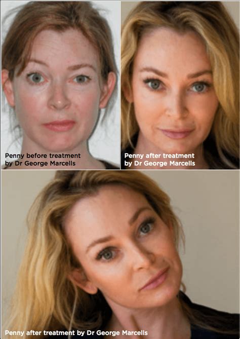 Around 40,000 people in the u.s. Treatment options for Bell's palsy | Dr. George Marcells