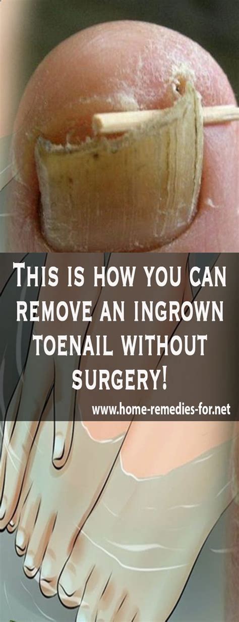 Ingrown hair is simply the hair that has always rolled up and return back to the skin. Pin on health