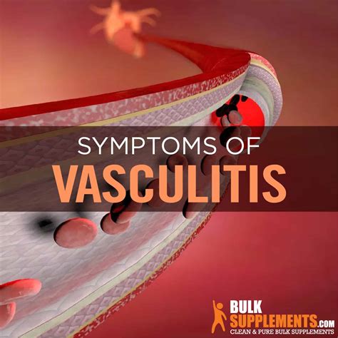 Vasculitis Symptoms Causes And Treatment By James Denlinger