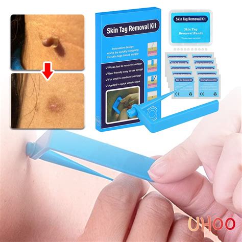 skin tag remover kit warts removal tools with cleaning pads rubber bands face care quick