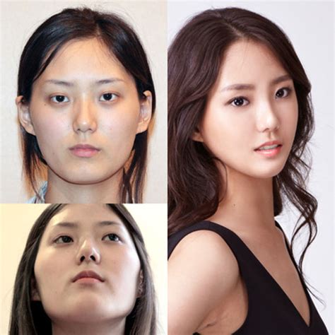 Before And After Photos Of Korean Plastic Surgery Part 2 62 Pics