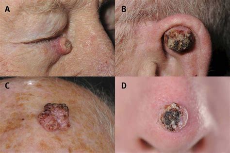 Facial Cutaneous Squamous Cell Carcinoma The Bmj