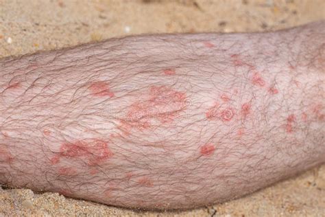 Part Of A Male Leg With Psoriatic Plaques Covered With Hair Skin