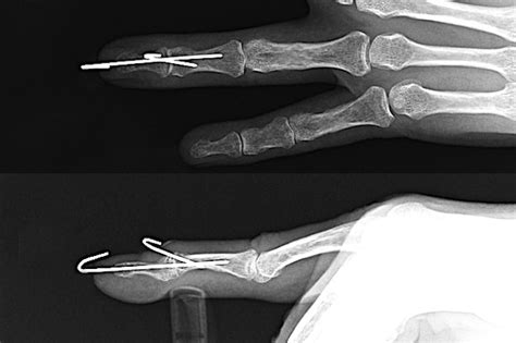 Finger Distal Phalanx Fracture Hand Surgery Source