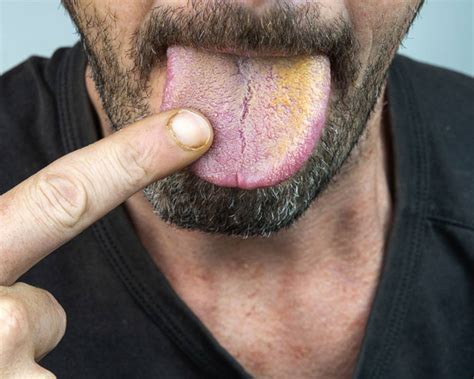 Causes Symptoms And Treatment Of Yellow Tongue Fatty Liver Disease