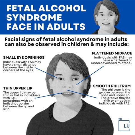 fetal alcohol syndrome in adults symptoms facial signs