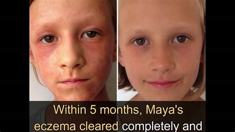 Mother Cures Child Suffering With Severe Eczema Youtube