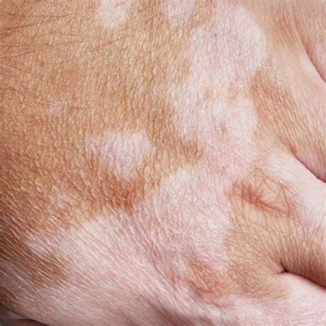 What Are Pigmented Lesions And How Can They Be Treated