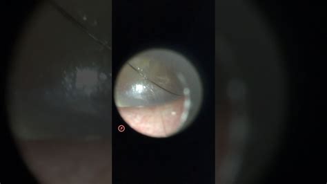 Small Ruptured Tympanic Membrane Right Perforated Ear Drum Youtube