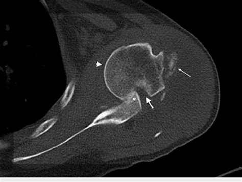 Ct Scan Axial Section Of The Left Shoulder Showing The Anteriorly
