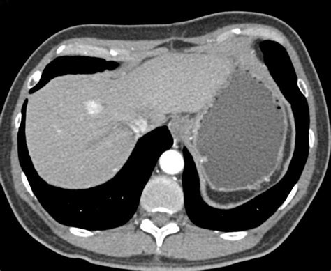 Neuroendocrine Tumor Pancreas Metastatic To The Liver Pancreas Case