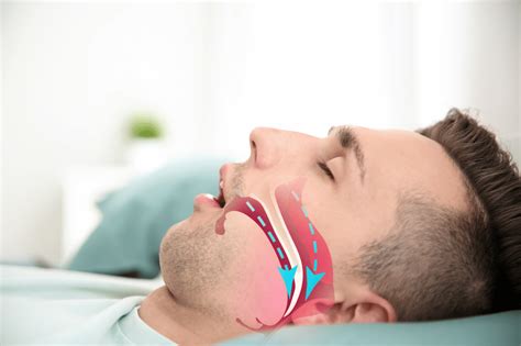 Diagnosing And Treating Obstructive Sleep Apnea Boulder Dentist
