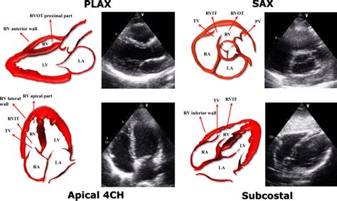 Echocardiographic Assessment Of The Right Ventricle This Figure Shows