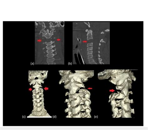 Ct Of The Cervical Spine A Coronal B Sagittal C Ct 3d