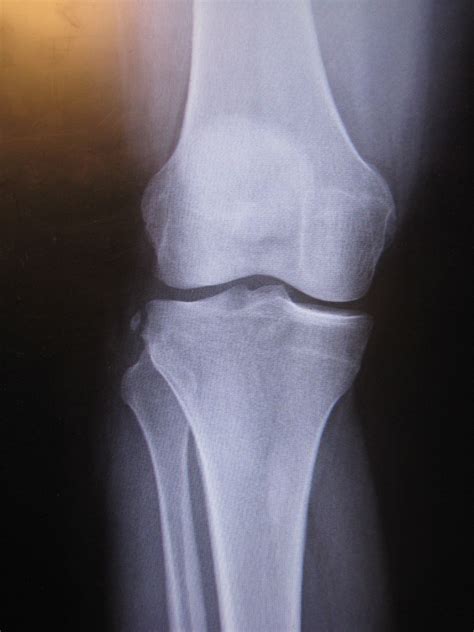 Knee X Rays