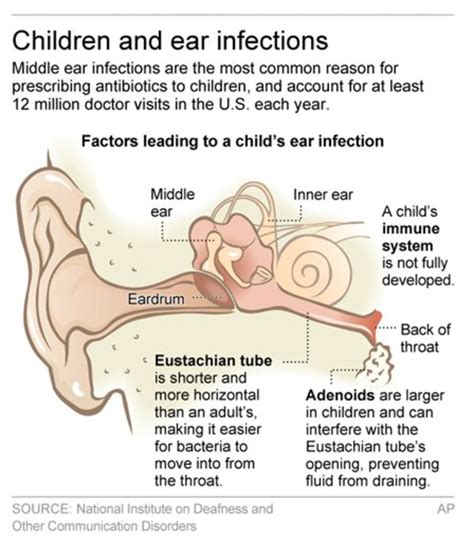 Antibiotic Gel Might Be Better Option For Ear Infections