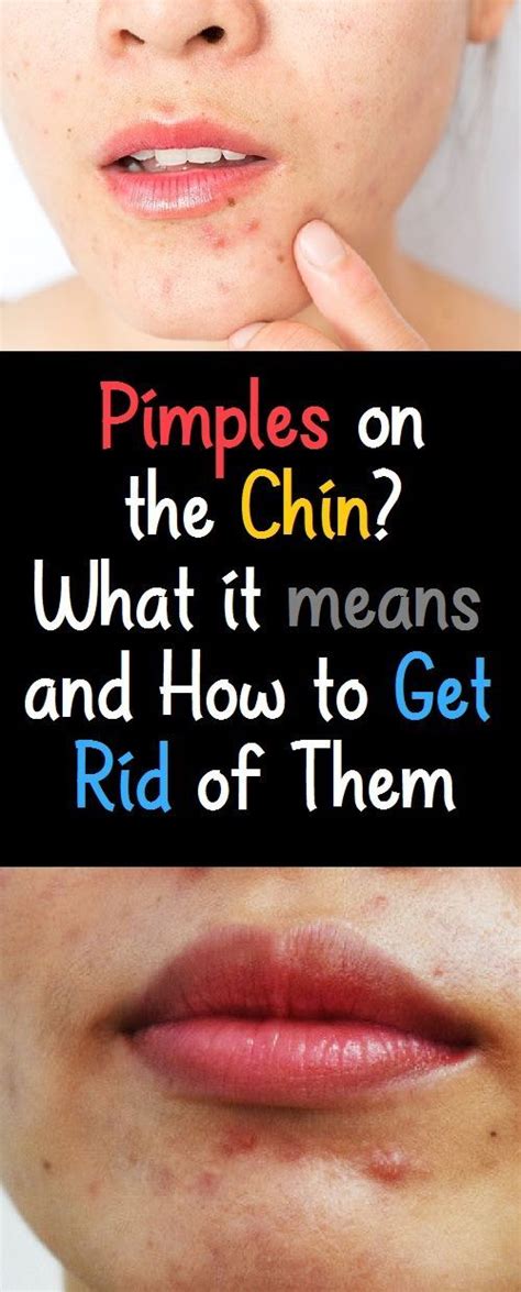 Get Rid Of Bumps Under Chin Get Rid Of Bumps