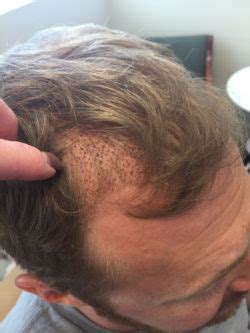 May 22, 2019 no comments. How Do Hair Transplants Work? | Utah Hair MD | SLC, Utah