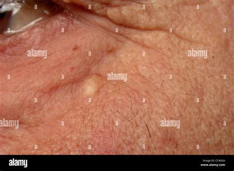 Sebaceous Cyst Hi Res Stock Photography And Images Alamy