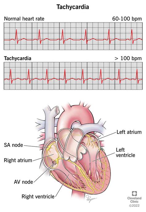 Tachycardia Symptoms Causes Treatment