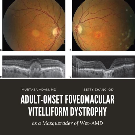 Adult Onset Foveomacular Vitelliform Dystrophy As A Masquerader Of Wet