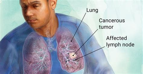 Tips Healthy 6 Signs Of Lung Cancer You Need To Know