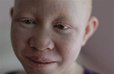 Malawi Les Albinos En Danger De Mort Tv5monde Informations