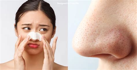 Those “black Dots” On Your Nose Arent Blackheads Heres What They