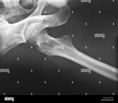 X Ray Of Human Hip Joint Stock Photo Alamy