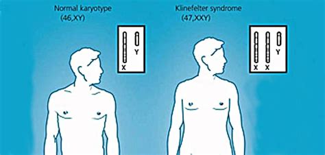 Klinefelter Syndrome Man