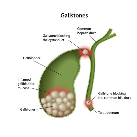 Gallstones Southern Surgical Care