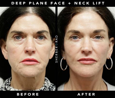Facial Cosmetic Surgery Washington Dc Facelift Northern Va