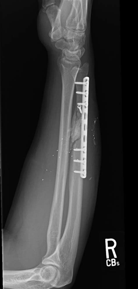 Isolated Ulnar Shaft Fracture Trauma Orthobullets Isolated Ulnar