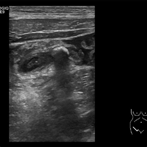 Appendicitis With Local Peritonitis 3 Days After Fig 1 Download