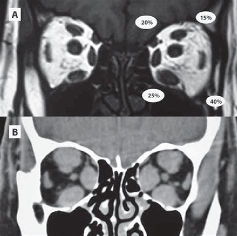 A Marked Fat Proliferation In The Retrobulbar Space With Minimal