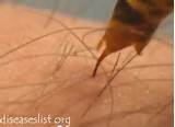 First Aid For Wasp Sting Images